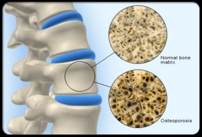 DECREASED BONE MINERAL DENSITY OF OSTEOPOROSIS